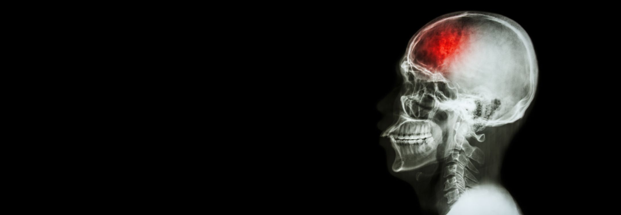 act-f-a-s-t-if-you-think-someone-is-having-a-stroke